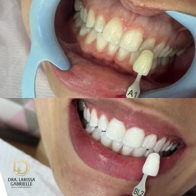 Clareamento+dental+diadema