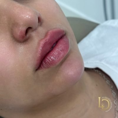 preenchimento+labial+em+são+bernardo